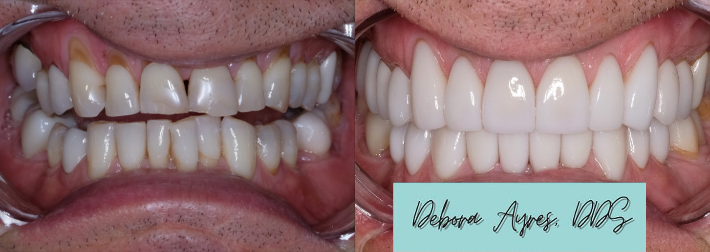 Dentist in Bee Cave, TX Before and After
