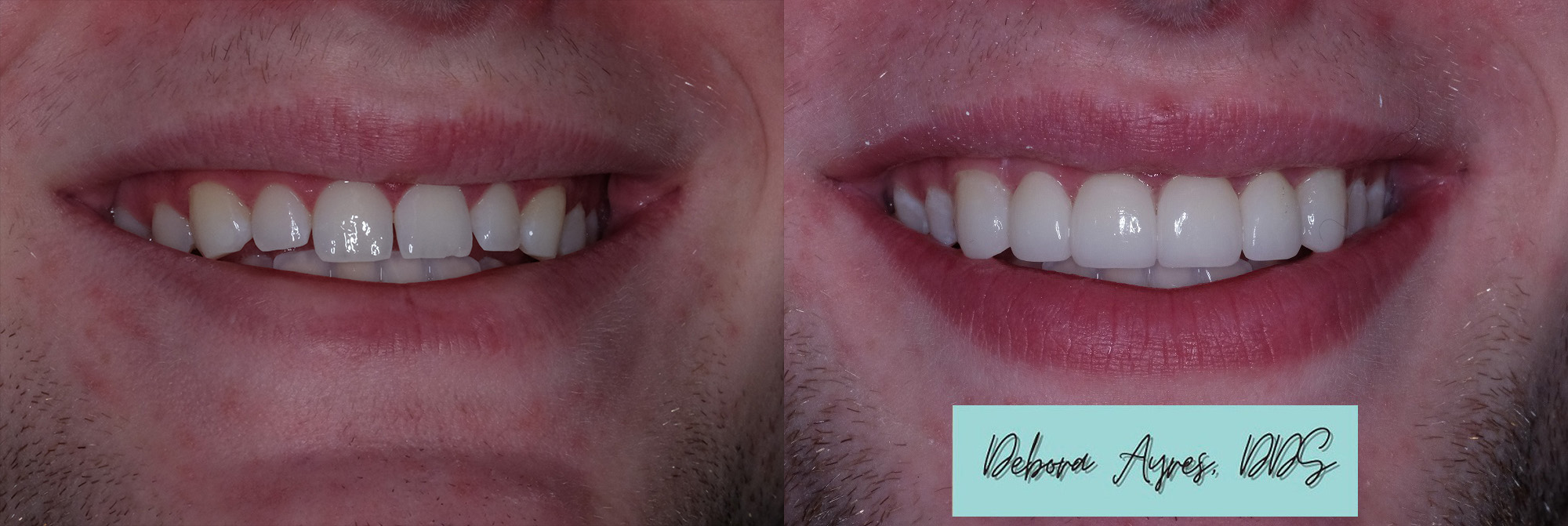 Dentist in Bee Cave, TX Before and After