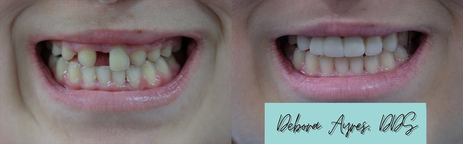 Dentist in Bee Cave, TX Before and After