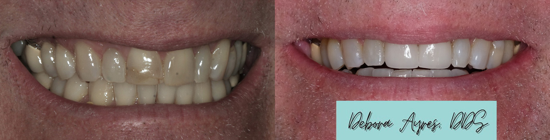 Dentist in Bee Cave, TX Before and After